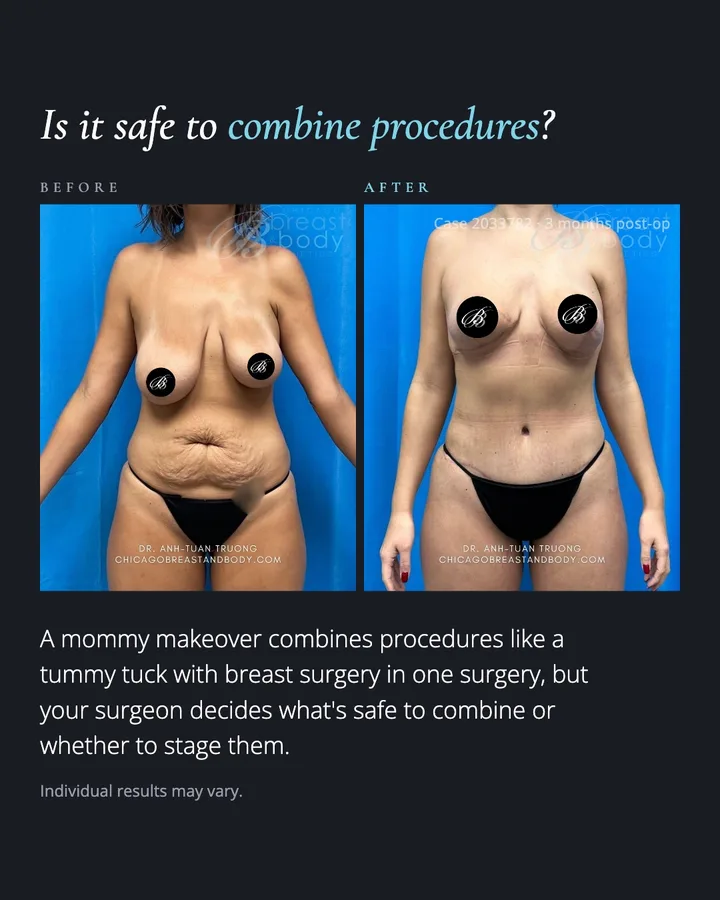 Carousel slide titled 'Is it safe to combine procedures?' with a front-view before and after photo pair and a short answer below