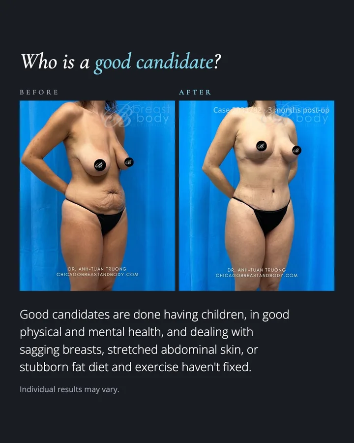Carousel slide titled 'Who is a good candidate?' with a three-quarter-view before and after photo pair and a short answer below