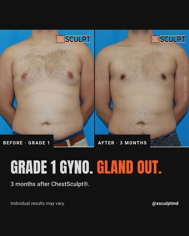 XSculpt carousel cover: front-view before and after chest photos with the headline 'Grade 1 gyno. Gland out.' and '3 months after ChestSculpt'