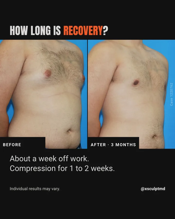 XSculpt slide titled 'How long is recovery?' with a before and after photo pair and a short answer