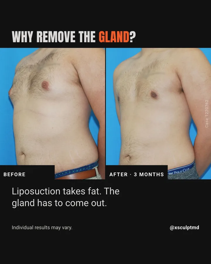 XSculpt slide titled 'Why remove the gland?' with an angled before and after photo pair and a two-line answer